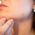 Traitement naturel de l’acné en naturopathie : 6 méthodes efficaces pour retrouver une peau saine!