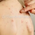 Pour une varicelle plus douce, vive les remèdes naturels !